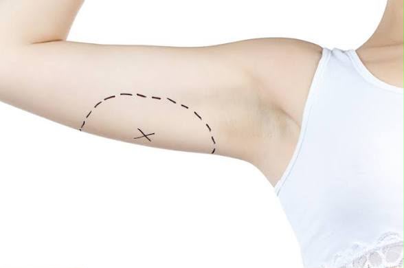 Arm lift brachioplasty surgery at EsteCenter Istanbul