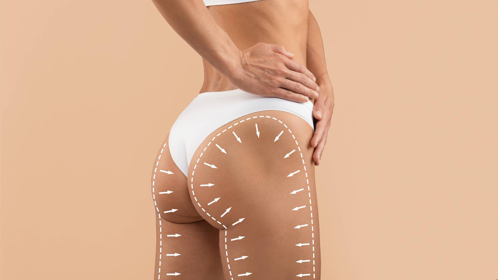 Brazilian Butt Lift BBL surgery at EsteCenter Istanbul