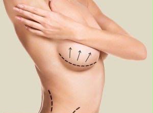 Breast lift mastopexy surgery at EsteCenter Istanbul