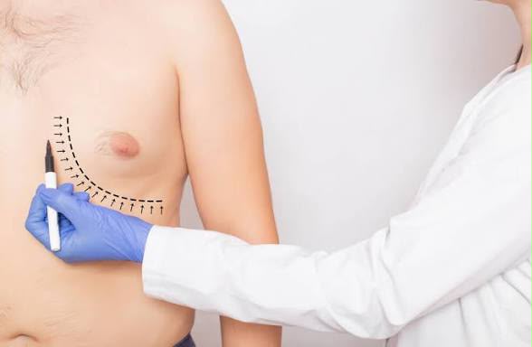 Gynecomastia male chest surgery at EsteCenter Istanbul