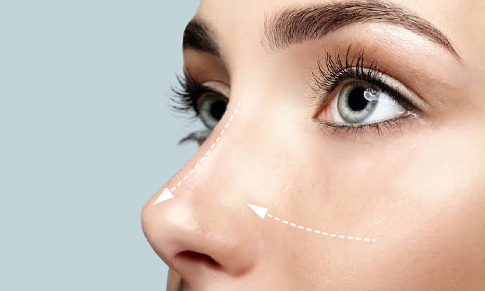 Septorhinoplasty combining nose shaping and airway correction at EsteCenter Istanbul