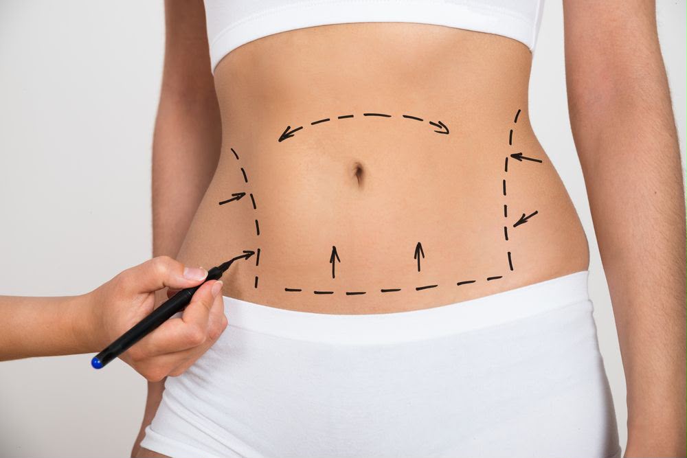 Tummy tuck abdominoplasty surgery at EsteCenter Istanbul