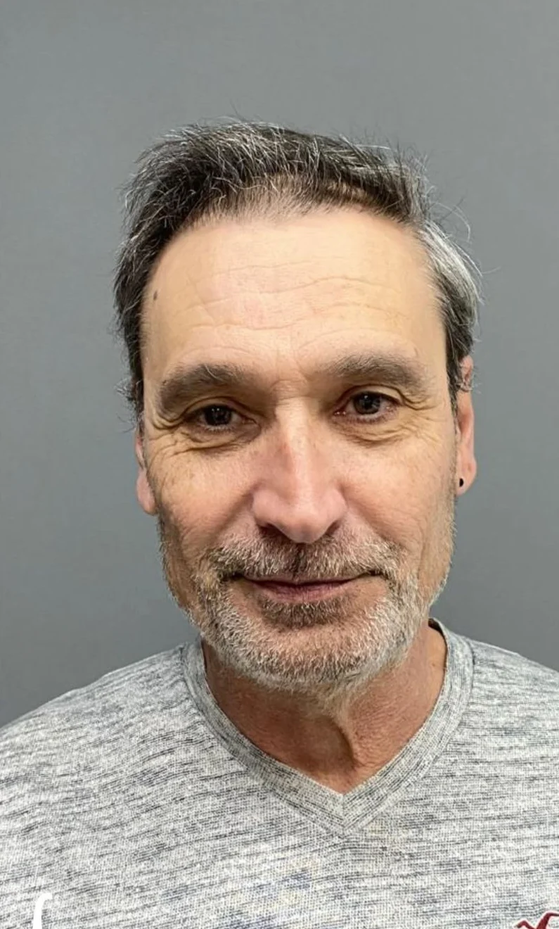 After hair transplant result — 3,600 grafts