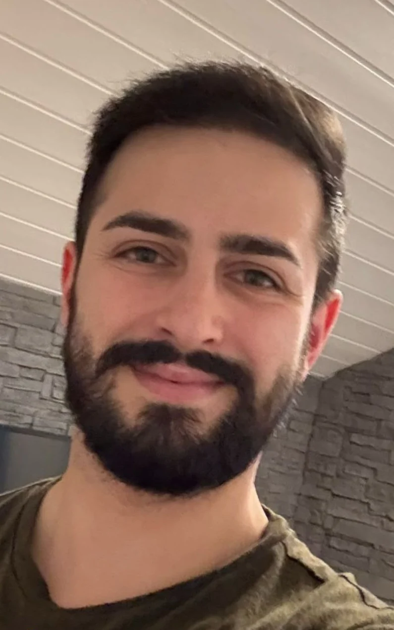 After hair transplant result — 1,120 grafts