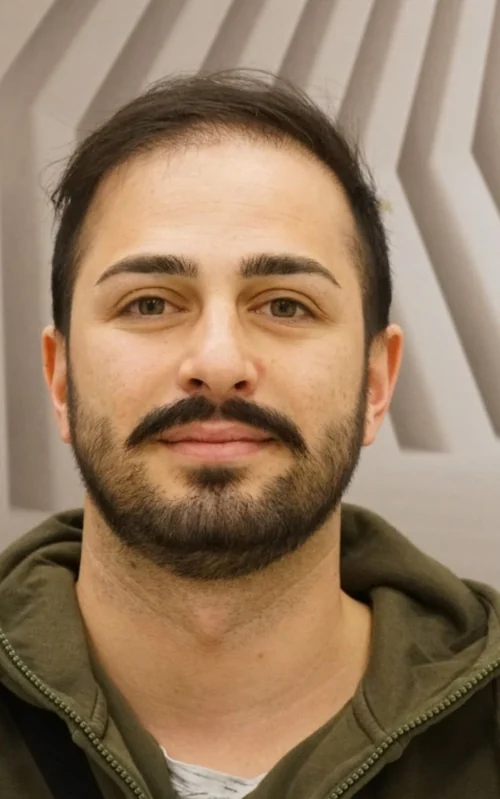 Before hair transplant