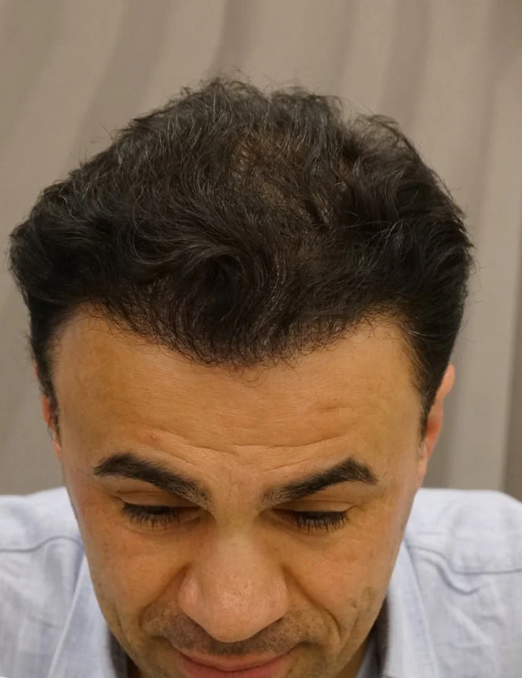After hair transplant result — crown restoration