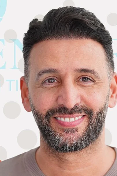 After hair transplant result — 2,100 grafts