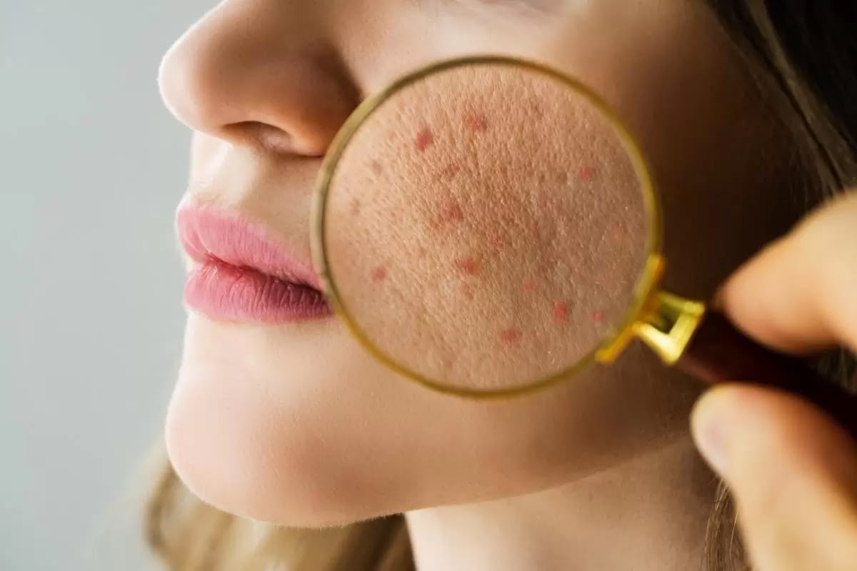 Acne treatment at EsteCenter Istanbul