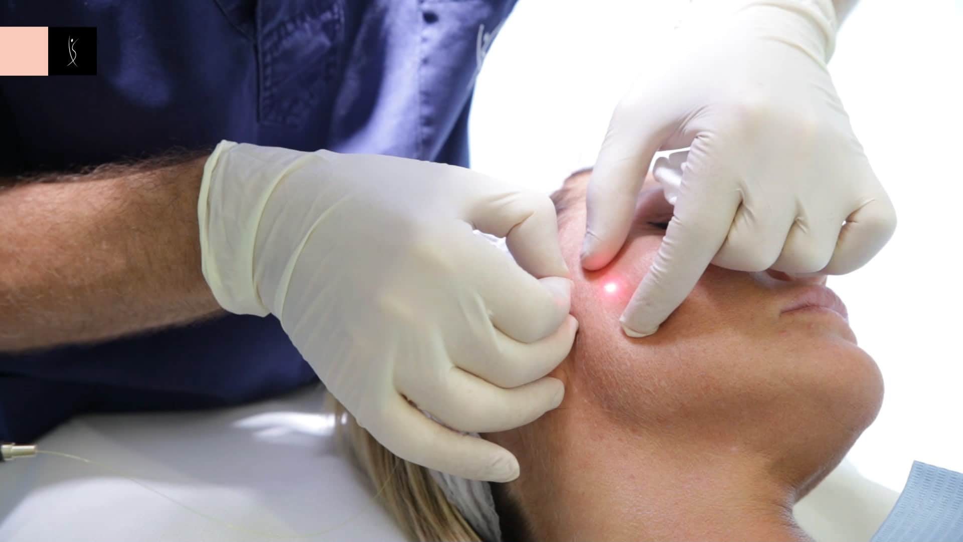 Endolift laser facelift at EsteCenter Istanbul