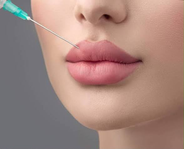 Lip filler treatment at EsteCenter Istanbul