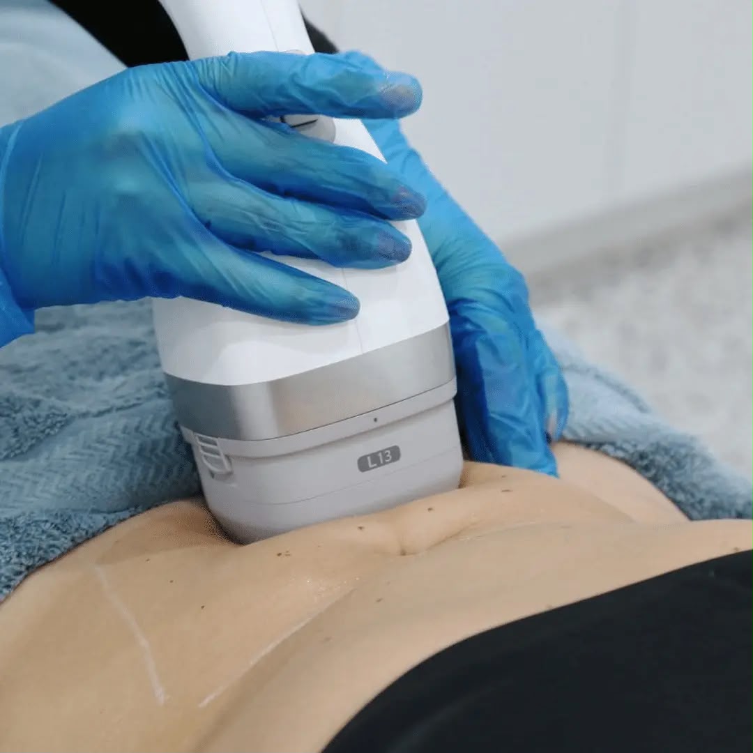 Lipocel Cool Sonic ultrasound fat reduction at EsteCenter Istanbul