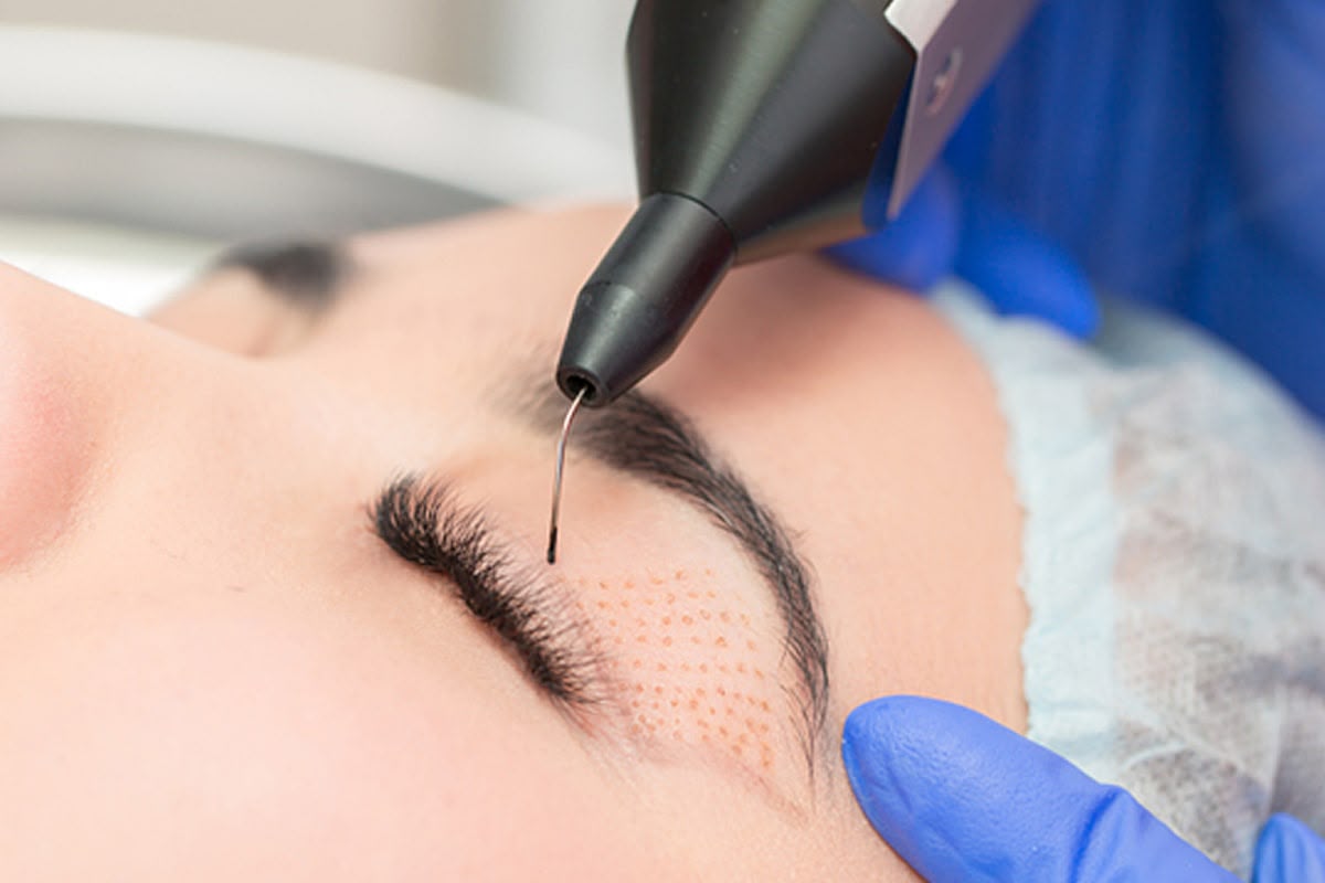 Plexr plasma soft surgery at EsteCenter Istanbul