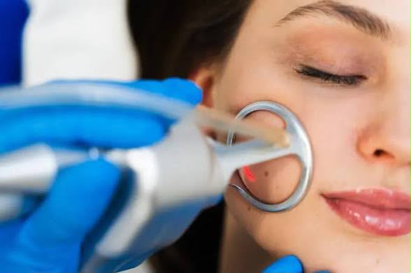 StarWalker laser skin treatment at EsteCenter Istanbul