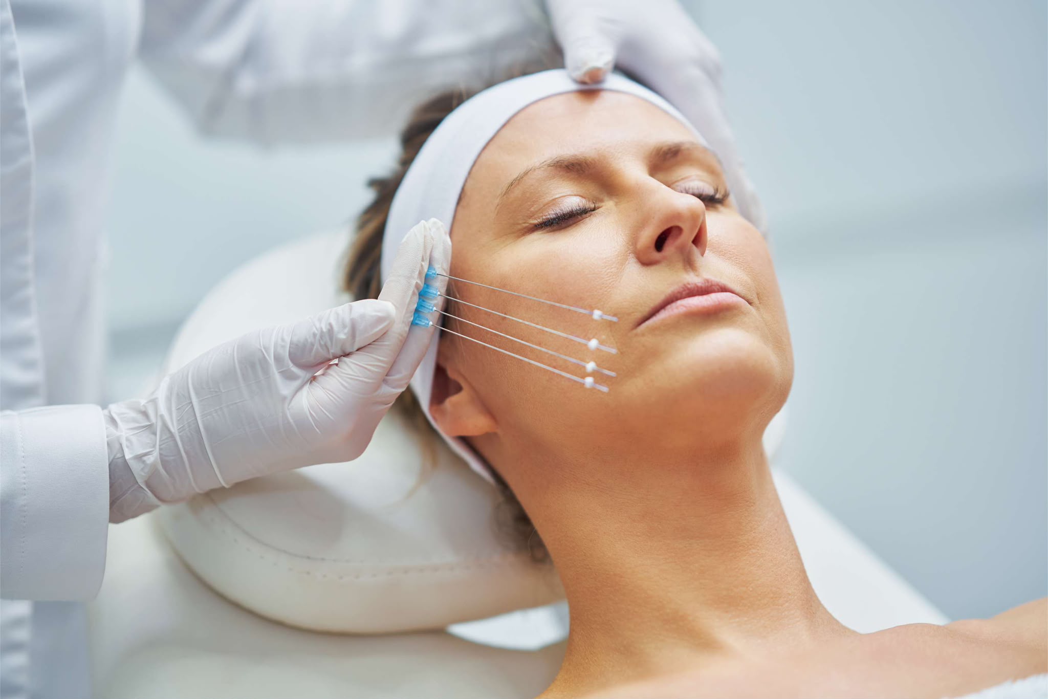 Thread lift PDO facial lifting at EsteCenter Istanbul